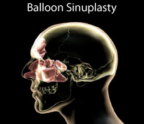 Balloon Sinuplasty