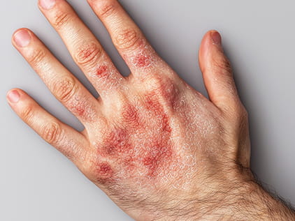 A hand with a visible rash or infection