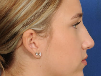 Nose Job | Plastic surgery in Johnson County