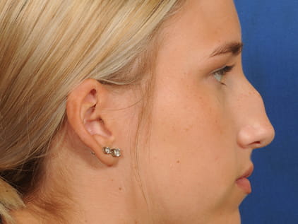 Before and after photos of Rhinoplasty | Kansas City & Olathe