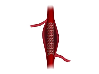 Diagram depicting stenting for stroke treatment
