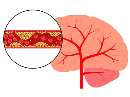 Diagram showing an Ischemic Stroke